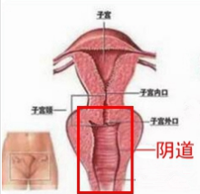 阴道松弛示意图