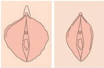 韩国丽姿阴唇整形效果示意图