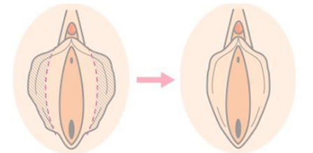韩国丽姿医院激光小阴唇整形效果图