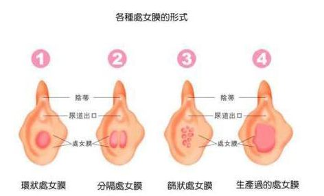 各种处女膜形式展示