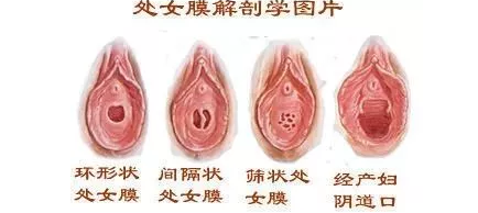 处女膜解剖学图片