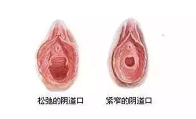正常的阴道和松弛的阴道