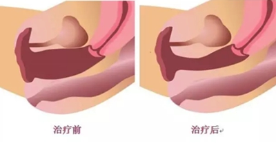 韩式阴道紧缩术效果