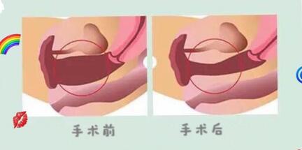 阴道紧缩术前术后对比效果