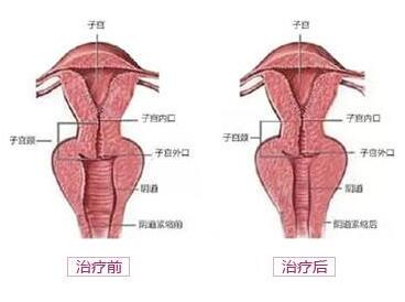 激光阴道紧缩前后对比照