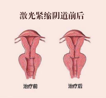 激光缩紧阴道术前术后示意图展示