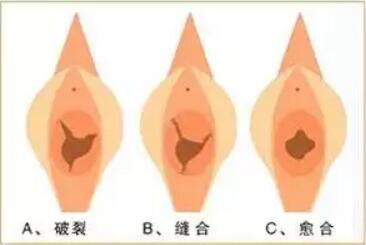 处女膜修复对比照