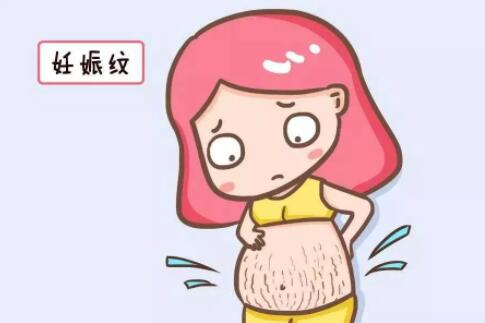 什么是妊娠纹？