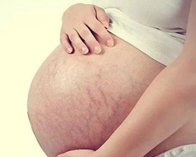 妊娠纹到底应该怎么治？