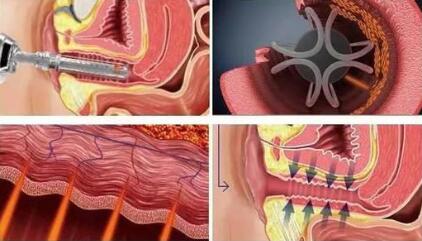 激光阴道紧缩